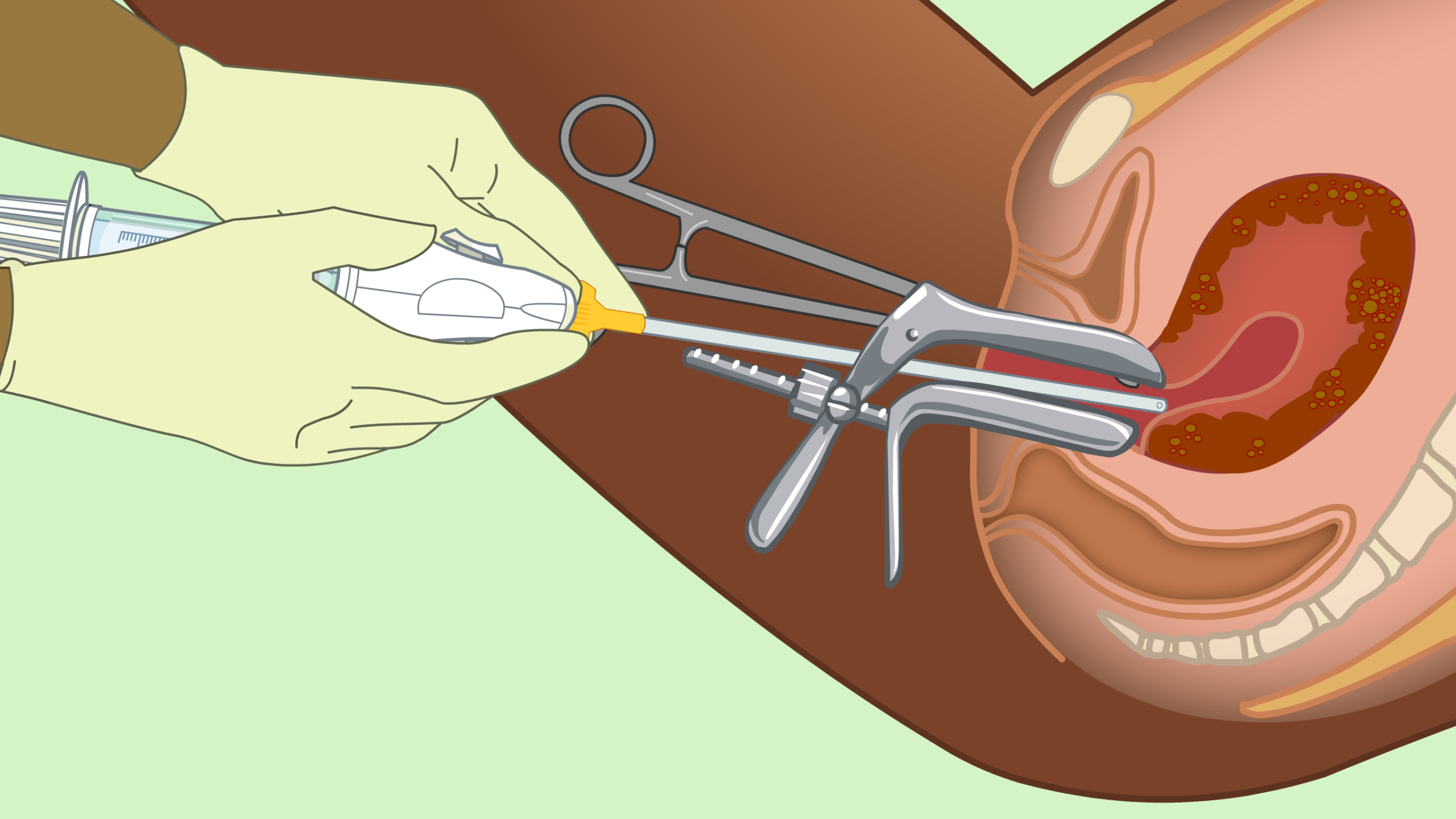 surgical abortion